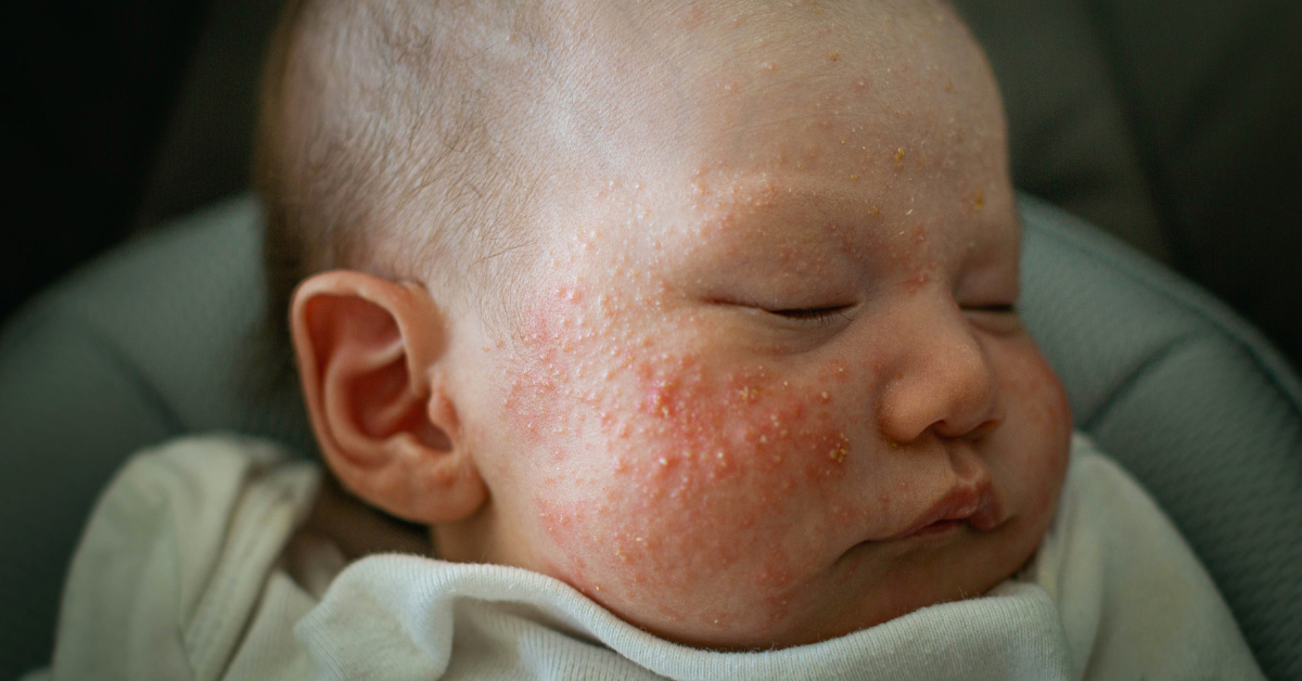 Baby Pickel im Gesicht